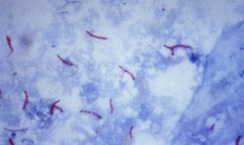 Как будут лечить туберкулез?