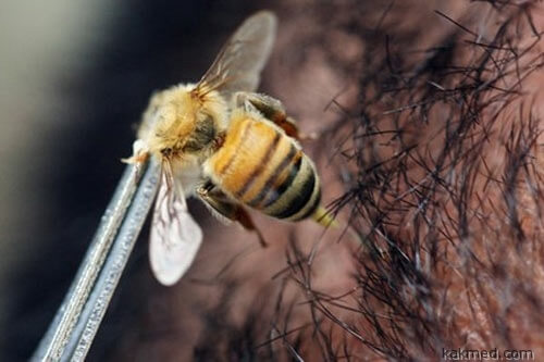Пчелиный яд против СПИДа