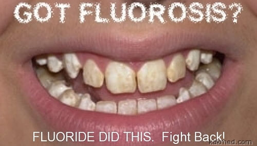 Флюороз и зубы