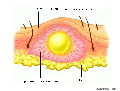 abscess