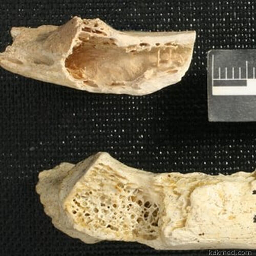 Кости неандертальцев с признаками рака