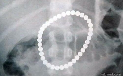 Ожерелье из 37 магнитов в животе ребенка