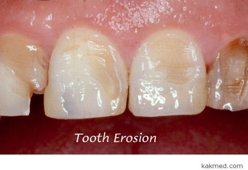 Эрозия зубной эмали