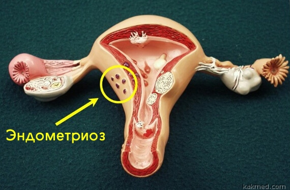 эндометриоз