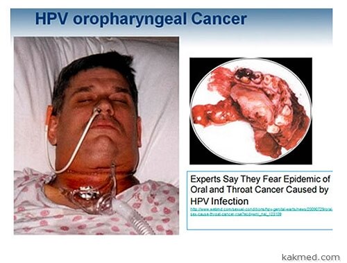 Вирус папилломы и рак гортани (горла)