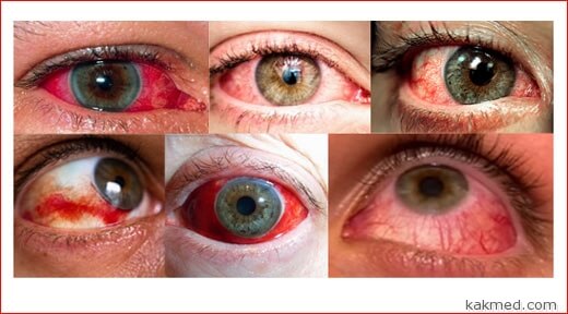 красные глаза причины и лечение
