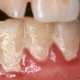 Небрежная чистка зубов усиливает риск смерти от рака на 80%