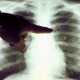 Заядлым курильщикам официально советуют систематически проверяться на рак легких