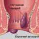 Как снять обострение при геморрое?