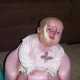 Британские врачи реконструируют лицо девочке, родившейся с чудовищной гемангиомой
