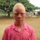 Негры-альбиносы в Либерии проходят бесплатную профилактику рака кожи