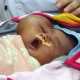 Ребенок с головой в форме сердца родился в Индонезии