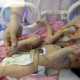 В Китае младенцу удалили пару ног и пару рук — разлучили с близнецом-паразитом