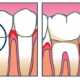 Как вылечить кровоточивость десен?