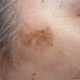 Возрастная пигментация кожи. Как бороться со старческими пятнами на коже?