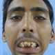 Индийский мальчик 8 лет прожил с закрытым ртом, пока ему не вставили новые челюстные суставы