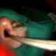 Индийский врач достал из носа пациента 50 живых опарышей, покушавшихся на его глаза