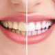 Как отбелить зубы в домашних условиях и стоит ли это делать?