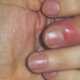Панариций: 8 способов лечения в домашних условиях