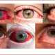 Красные глаза: причины и лечение